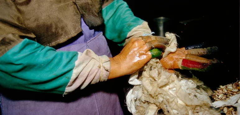 A Cashew nut processor wipes the caustic oil released during the deshelling process off her hands.